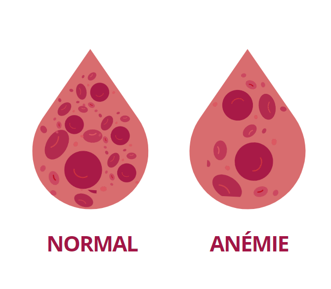 Annémie ferriprive la différence de globules rouges dans le sang