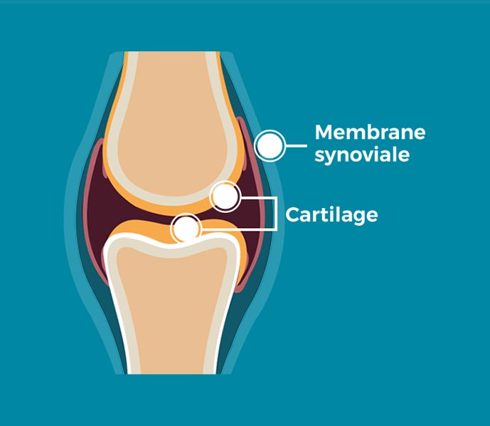 Soulager l'arthrose du genou (gonarthrose) : genouillère arthrose