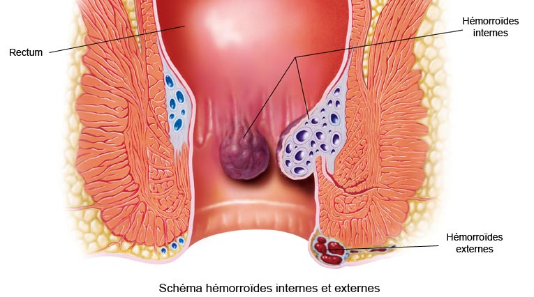 Schéma des hémorroïdes internes et externes